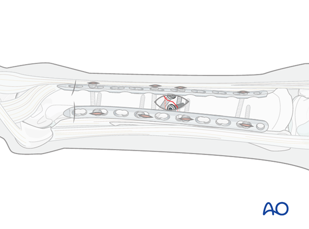 minimally invasive fixation
