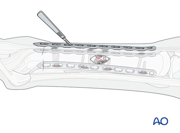 minimally invasive fixation