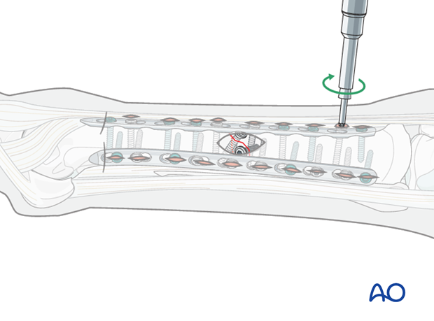 minimally invasive fixation
