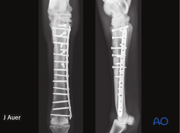 fixation with plates and screws