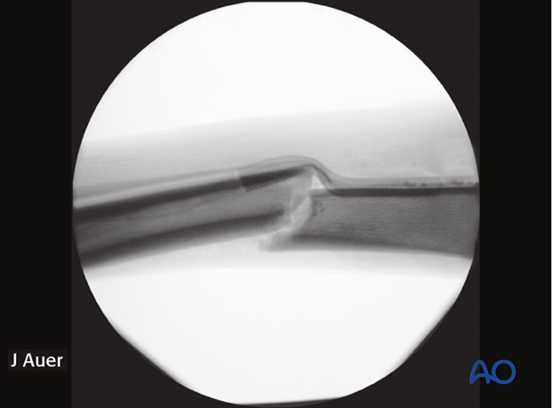 minimally invasive fixation