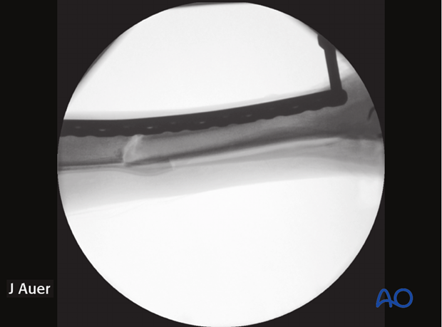 minimally invasive fixation