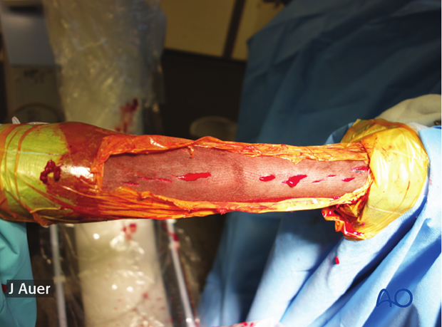 minimally invasive fixation