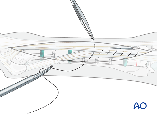 Plate fixation for Metacarpals/-tarsals III: Proximal simple fractures