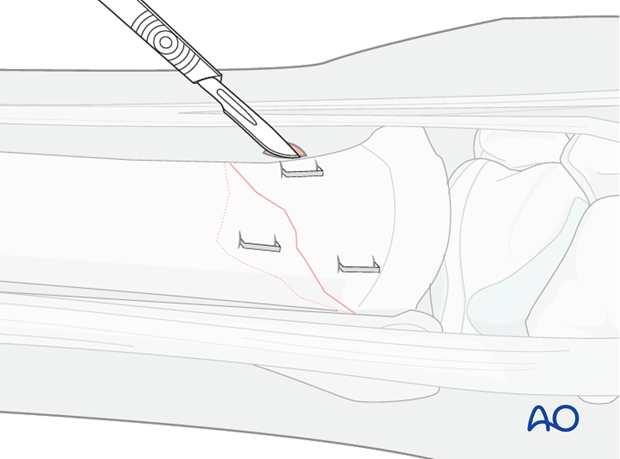 stab incision prox metaphysis