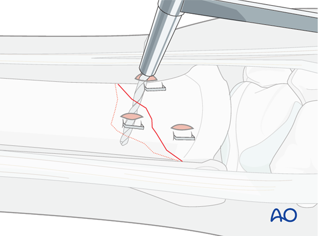 fixation with lag screw
