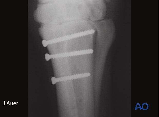 fixation with lag screw