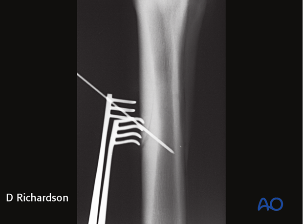 screw fixation with osteostixis