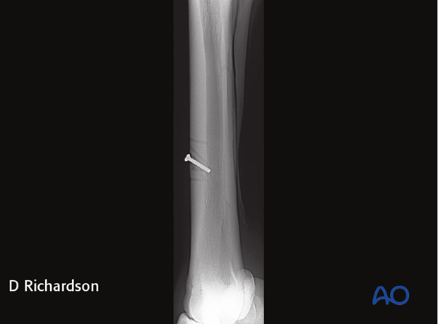 screw fixation with osteostixis