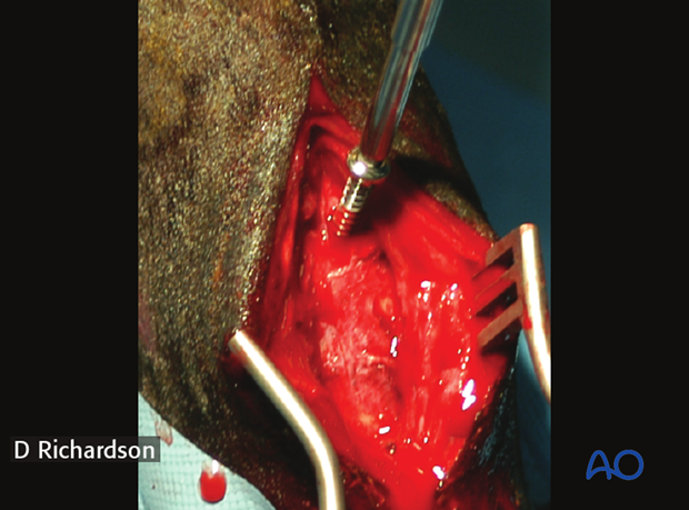 screw fixation with osteostixis