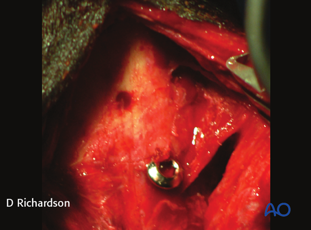 screw fixation with osteostixis