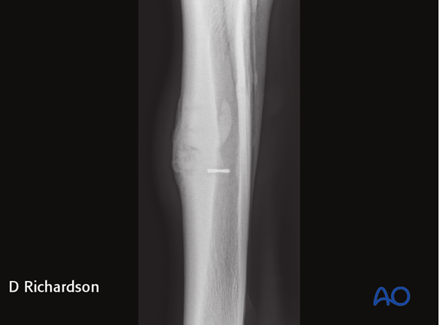 screw fixation with osteostixis