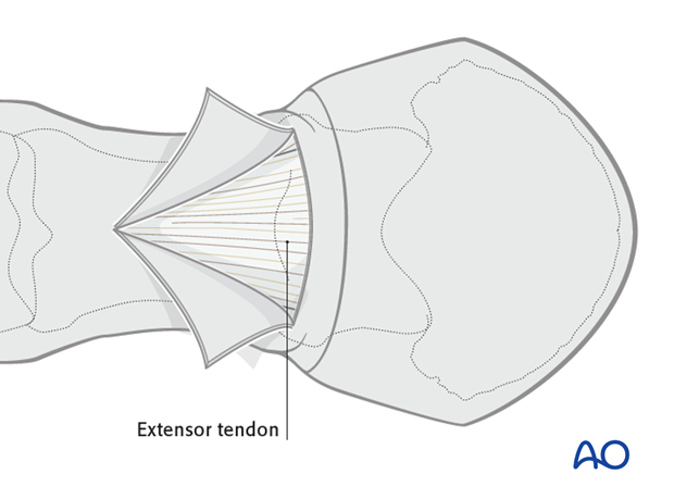 Abaxial dissection between the extensor tendon and the skin forms two flaps,...