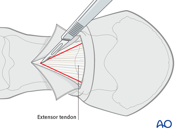 plate fixation transarticular lag screws