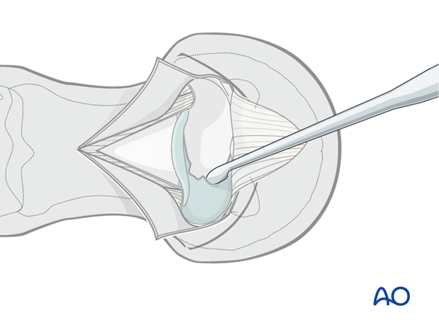 The articular cartilage is completely removed from the articular surfaces of the proximal and middle phalanx...