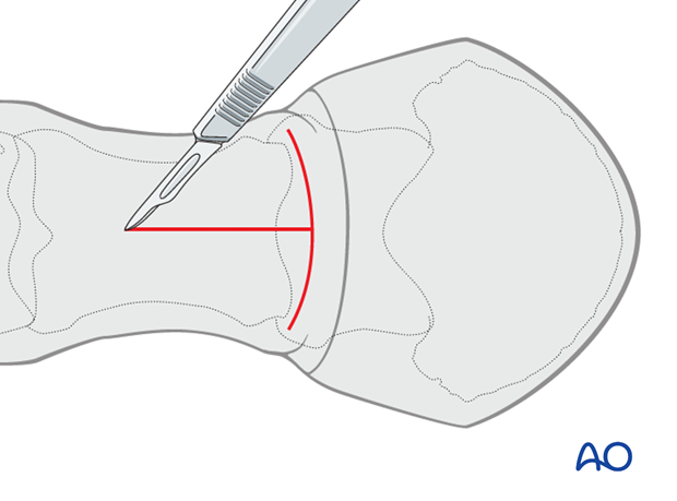 A longitudinal incision is made starting at the junction of the proximal and middle one third of the proximal phalanx...