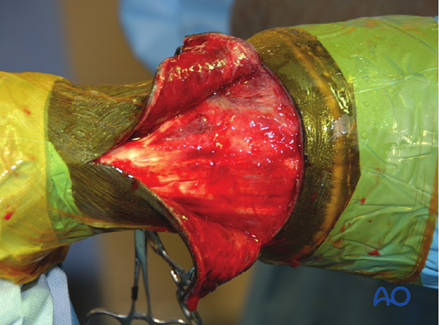 dorsal approach to the proximal interphalangeal pastern joint