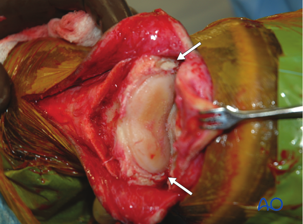 The joint is opened to allow complete removal of the articular cartilage. 
