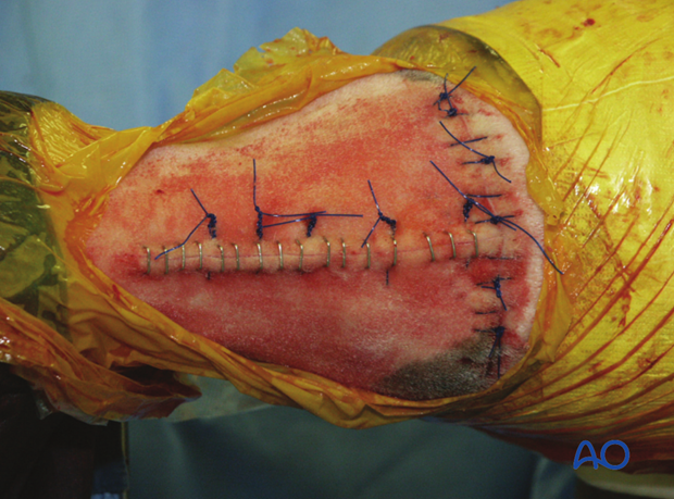 The skin incisions are closed routinely. Tension relieving sutures are applied as needed in the longitudinal incision.