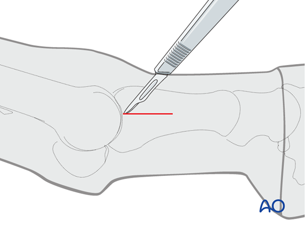 Standard lateral approach
