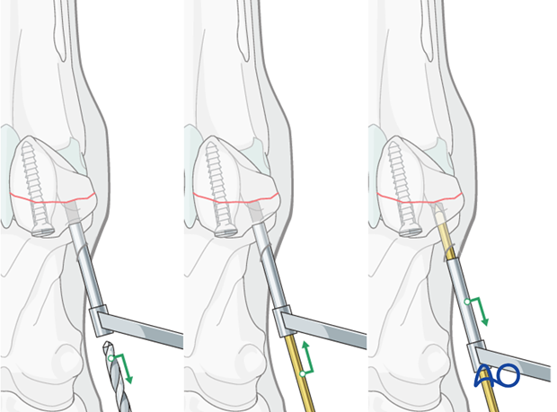 Midbody fracture of the proximal sesamoid bone - screw fixation