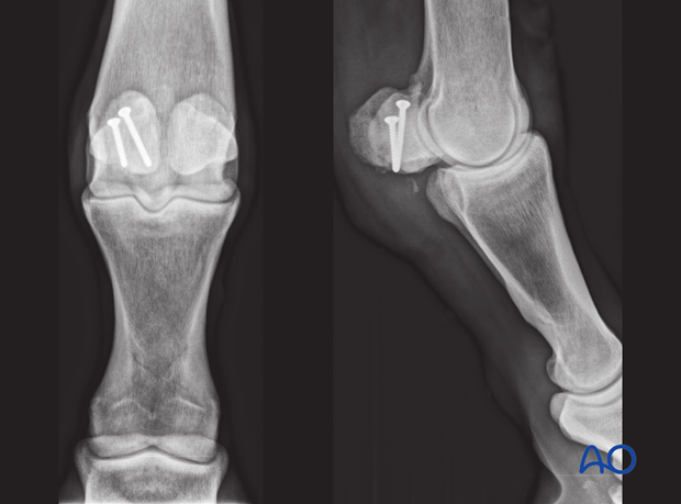 Midbody fracture of the proximal sesamoid bone - screw fixation