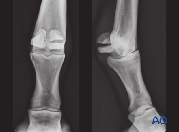 Fractures of the proximal sesamoid bones - all fracture types