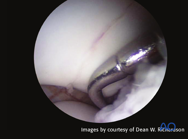 Midbody fracture of the proximal sesamoid bone - screw fixation