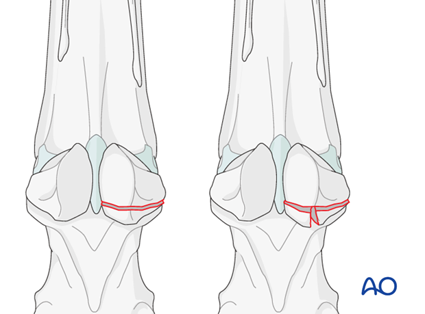 Fractures of proximal sesamoid bones - basilar fractures