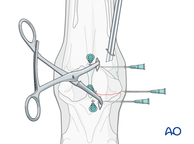 Basilar fracture of the proximal sesamoid bone - screw fixation