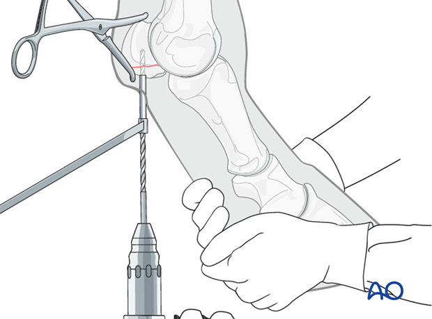 Basilar fracture of the proximal sesamoid bone - screw fixation