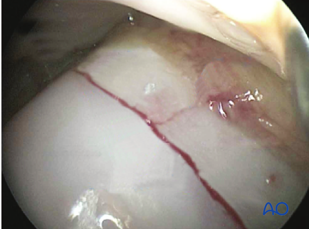 Basilar fracture of the proximal sesamoid bone - screw fixation