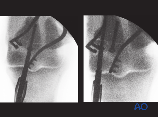 Basilar fracture of the proximal sesamoid bone - screw fixation