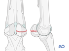 Midbody fractures of the proximal sesamoid bone