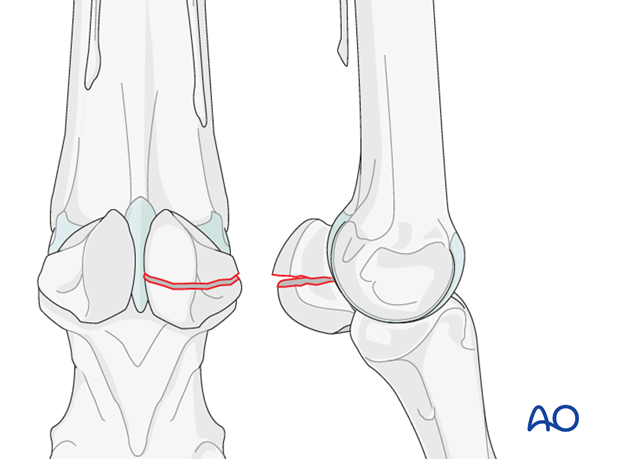 Fractures of proximal sesamoid bones - midbody fractures
