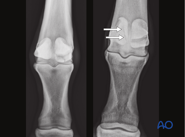 Fractures of proximal sesamoid bones - comminuted fractures