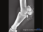 Comminuted fractures of the proximal sesamoid bone