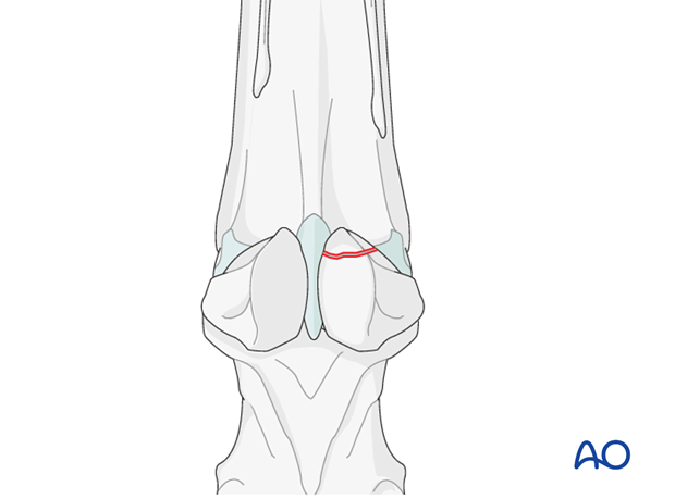 Fractures of proximal sesamoid bones - apex fractures
