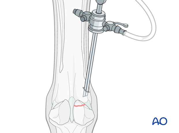 Apex fracture of the proximal sesamoid bone - removal