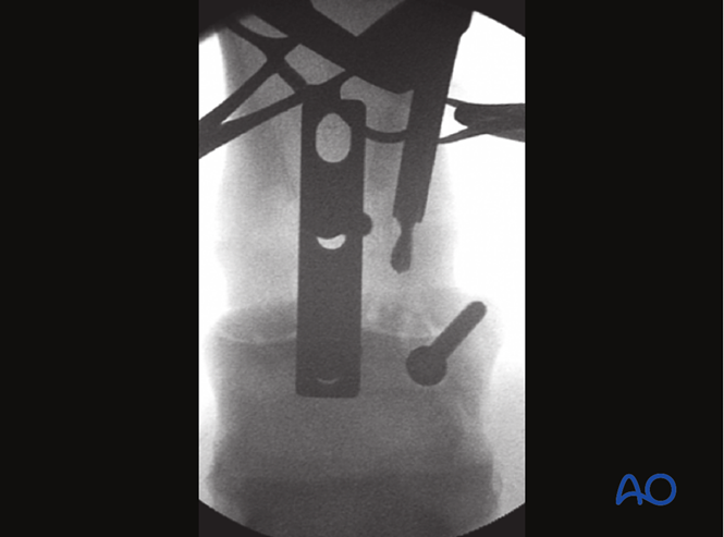 Fixation with a DCP or LC-DCP