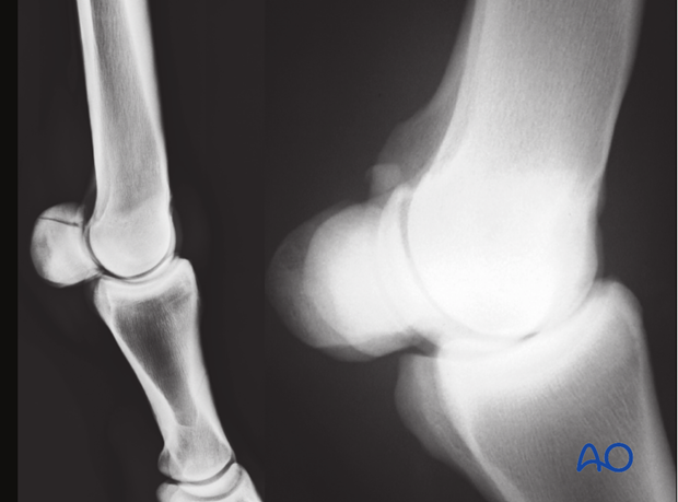 Fractures of proximal sesamoid bones - apex fractures