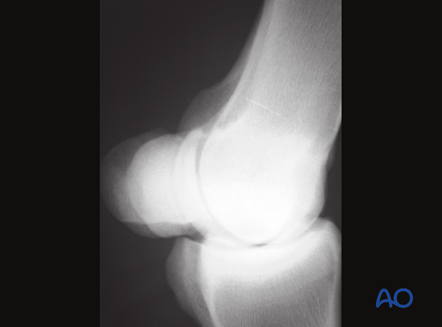 Apex fracture of the proximal sesamoid bone - removal