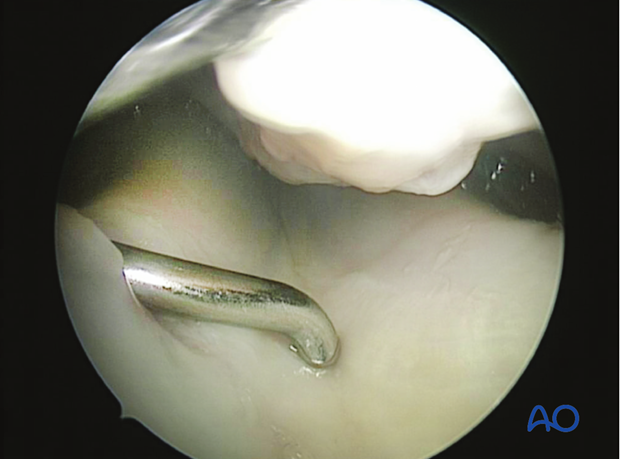 Apex fracture of the proximal sesamoid bone - removal