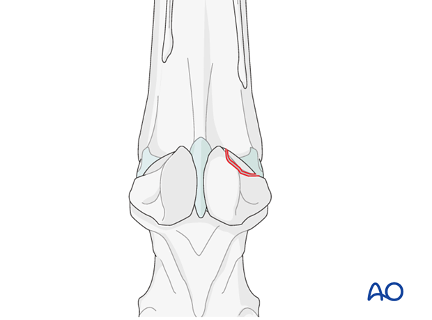 Fractures of proximal sesamoid bones - abaxial fractures