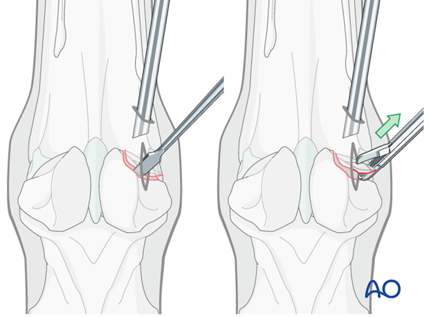 Abaxial fracture of the proximal sesamoid bone - removal