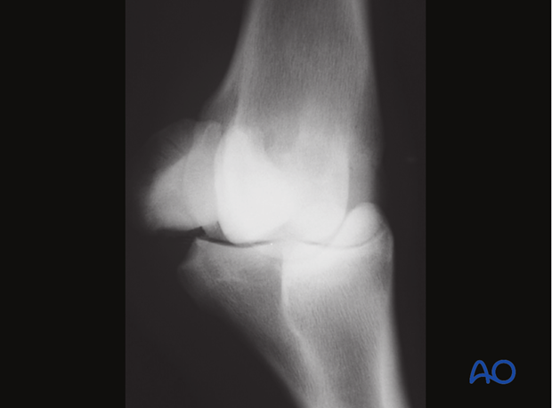 Base fracture of the proximal sesamoid bone - removal