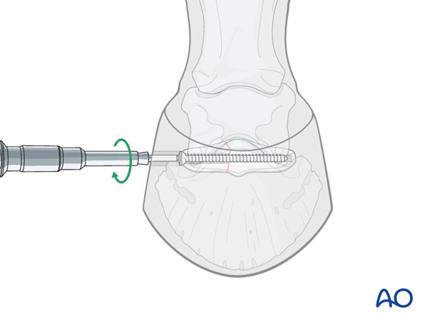 Fracture of the distal sesamoid bone - screw fixation