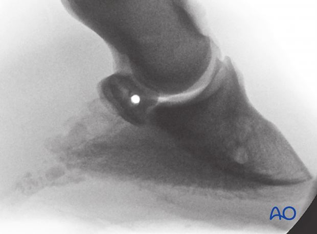 Fracture of the distal sesamoid bone - screw fixation
