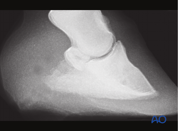 Fracture of the distal sesamoid bone - screw fixation