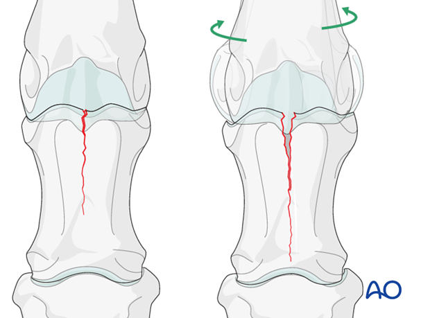 Torsional forces caused by the anatomical configuration of the sagittal groove of the proximal phalanx